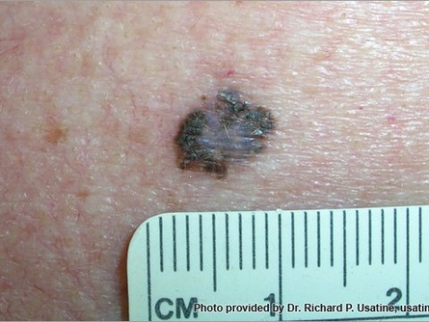 Skin Cancer