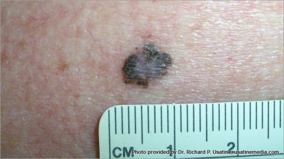 Skin Cancer