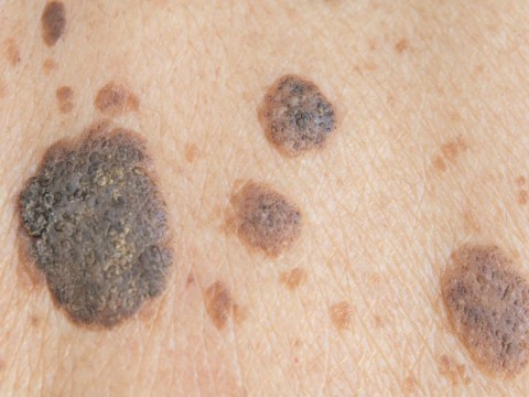 Benign Skin Lesions