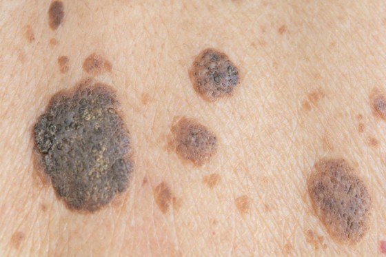 Benign Skin Lesions